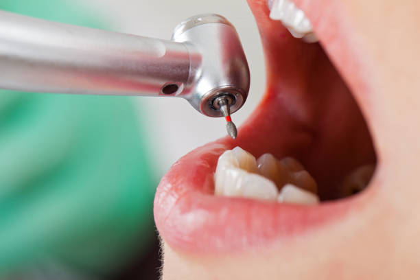 Best Emergency Dentist for Knocked-Out Tooth in Colma, CA